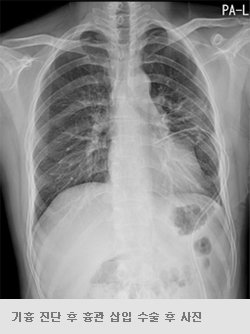 기흉 진단 후 흉관 삽입 수술 후 사진